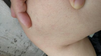 ​腿上有“红血丝”的人：要注意了！这可能是身体发出的危险信号！