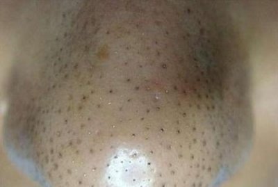 ​草莓鼻怎么办怎么去除草莓鼻(怎么快速去除小草莓)