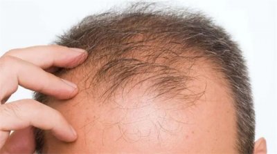 ​新冠感染后为什么不停脱发？