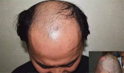 ​喝含糖饮料导致脱发的原因有哪些？